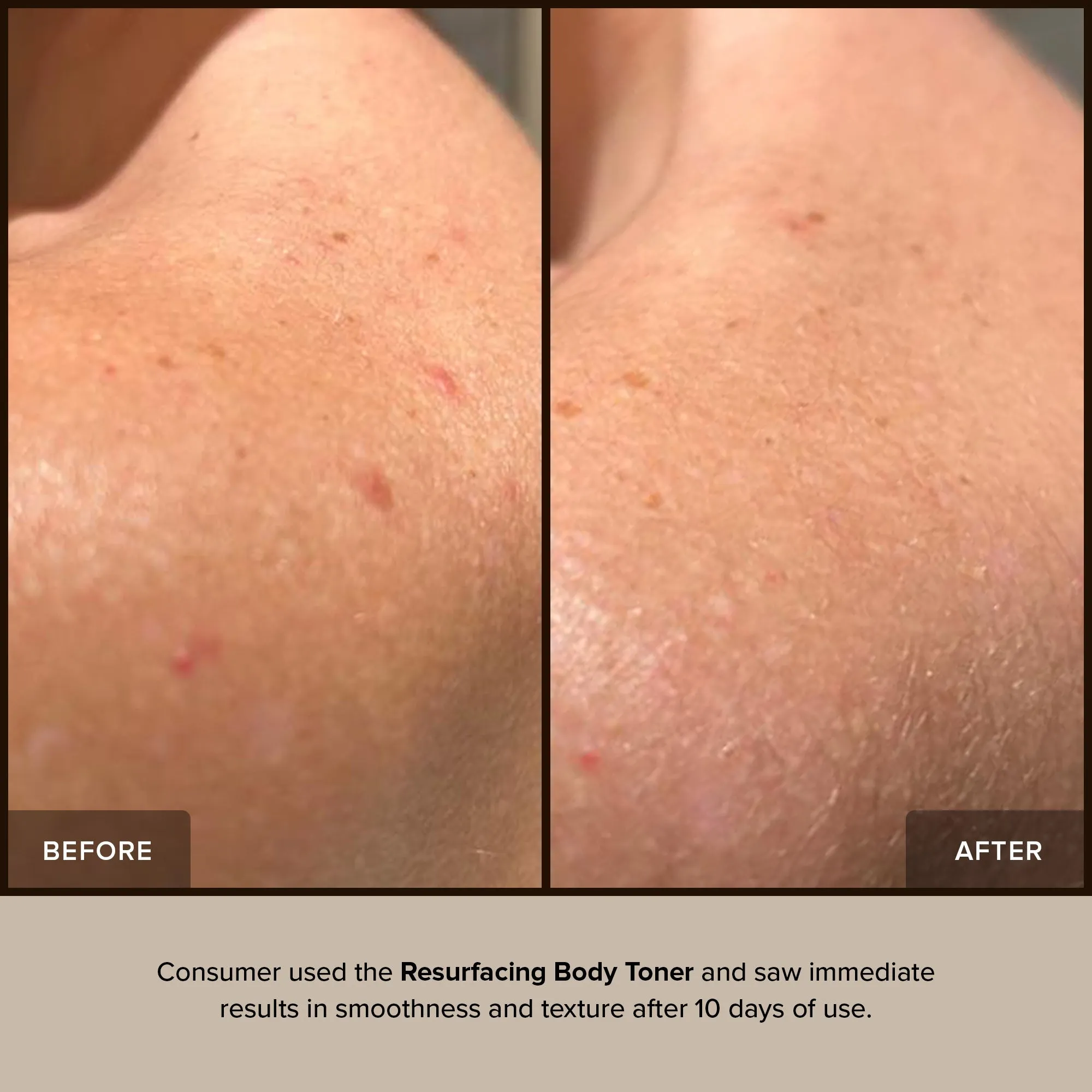 RESURFACING BODY TONER